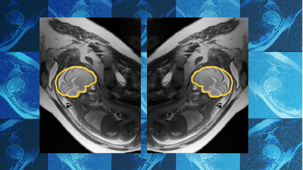 Why teaching AI about symmetry could make prenatal diagnosis more reliable | MIT News